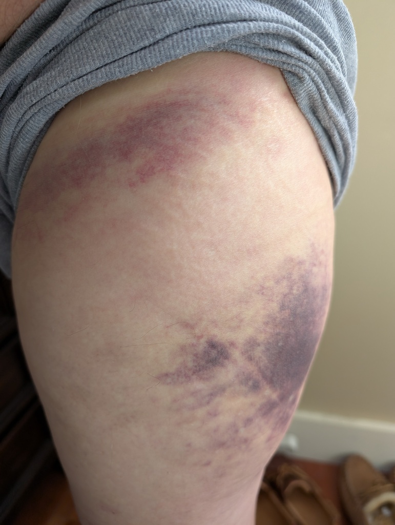 No description provided for: /2025/07-09/0729-thigh-bruise/photo01.html